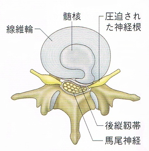 腰椎椎間板ヘルニア